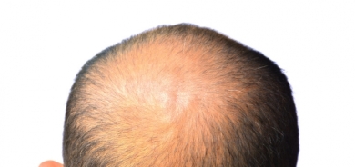 دواء جديد لاستعادة الشعر بالكامل لدى المصابين بهذا المرض المناعي!