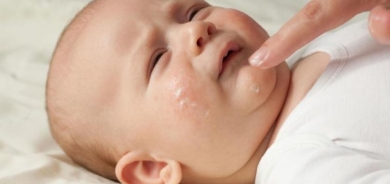 علاج جديد للأطفال المصابين بـ«الإكزيما الشديدة»