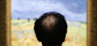 دواء جديد يعيد الشعر لمرضى الثعلبة بنسبة 80 %