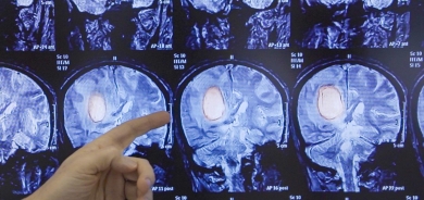 علاج جديد للحد من ورم في المخ يصيب الشباب