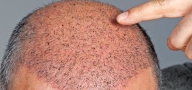 7 خرافات حول عمليات زراعة الشعر!
