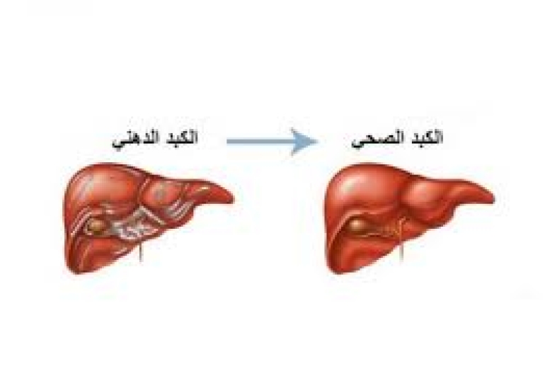 طريقة طبيعية لعكس مرض الكبد الدهني