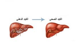 طريقة طبيعية لعكس مرض الكبد الدهني