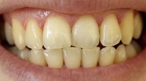 طرق التخلص من البقع البنية على الأسنان