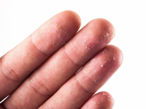 أفضل 5 علاجات منزلية لمنع تقشير أطراف الأصابع